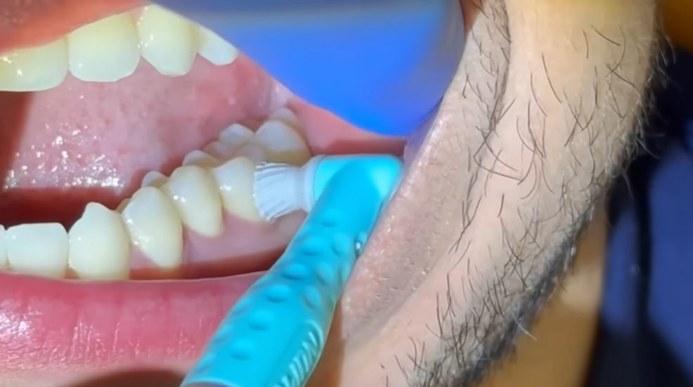 Prevention Tips for Reducing Post-Extraction Discomfort