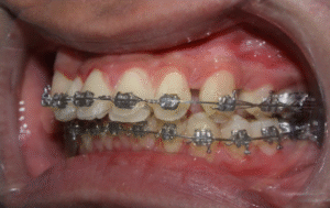 Benefits of Modern Bonding Techniques