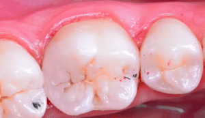 The Risks of Ignoring a Cracked Filling