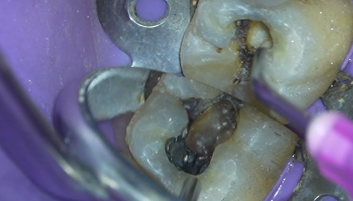 Diagnosing Cracked Tooth Syndrome