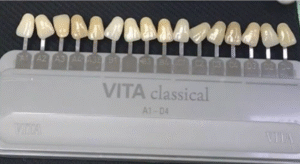 Benefits of Choosing Lumineers