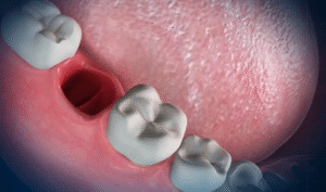 Common Causes of Throbbing Pain After Tooth Extraction