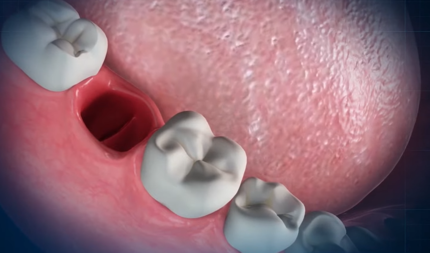 Common Causes of Throbbing Pain After Tooth Extraction