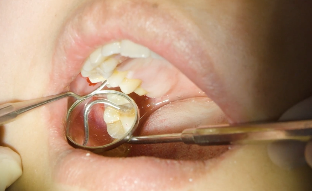 Root Canal Therapy: The Classic Example of Endodontic Treatment