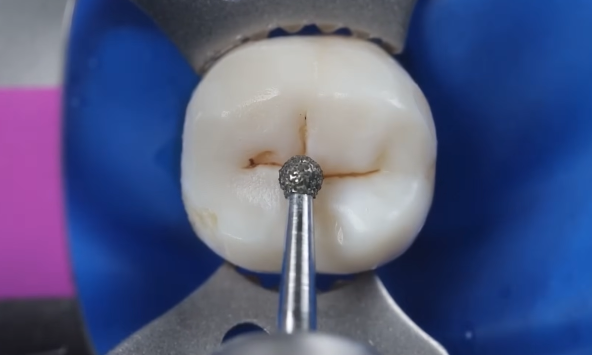 Pulpotomy: A Partial Endodontic Treatment Option