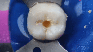 Pain Management During and After Endodontic Procedures