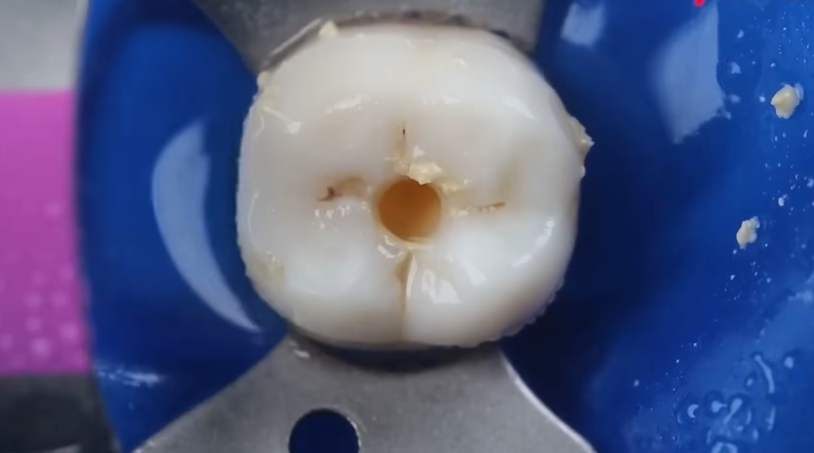 Pain Management During and After Endodontic Procedures
