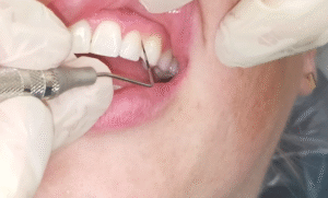 When to See a Dentist About Tooth Sulcus