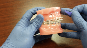 Common Mistakes to Avoid When Putting on Elastics