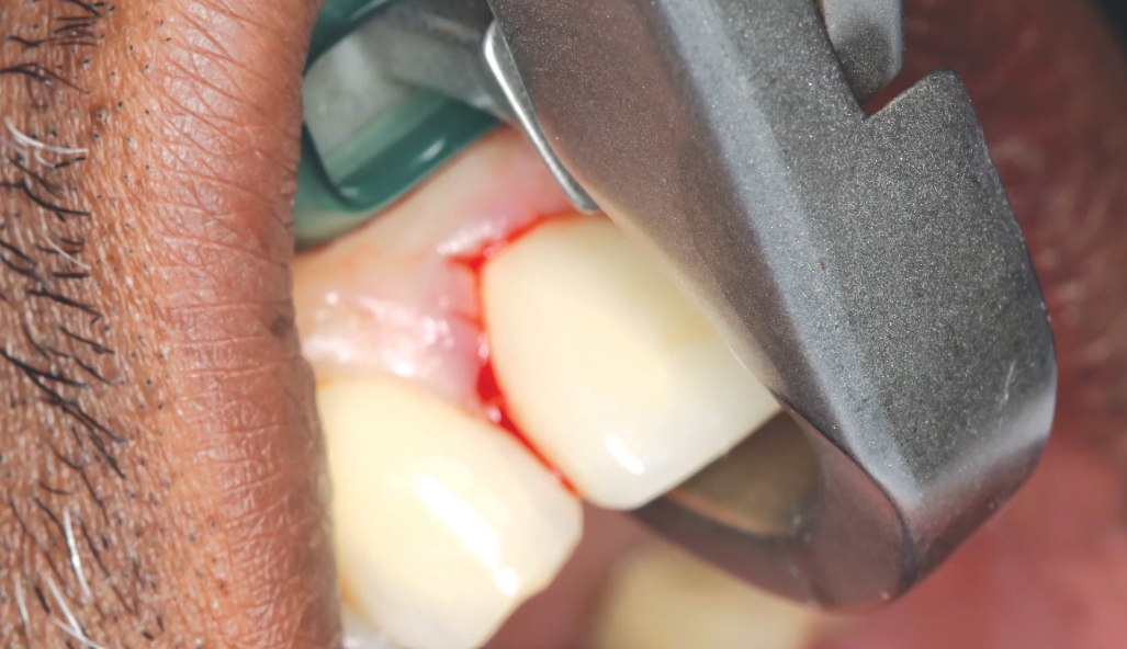 When Same-Day Bone Graft and Implant Make Sense