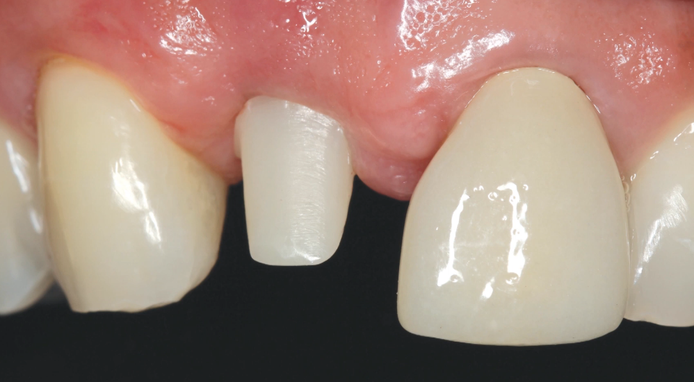 Benefits of Doing the Bone Graft at the Time of Implant