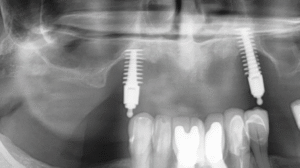 Removal Techniques and Tools