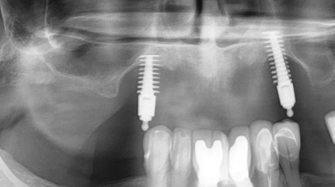 Removal Techniques and Tools