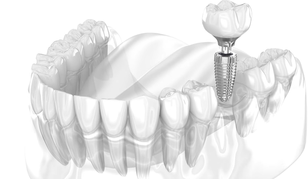 Understanding Titanium Teeth: A Simple Explanation