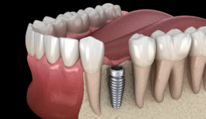 Being Honest: Are There Any Drawbacks to Titanium?