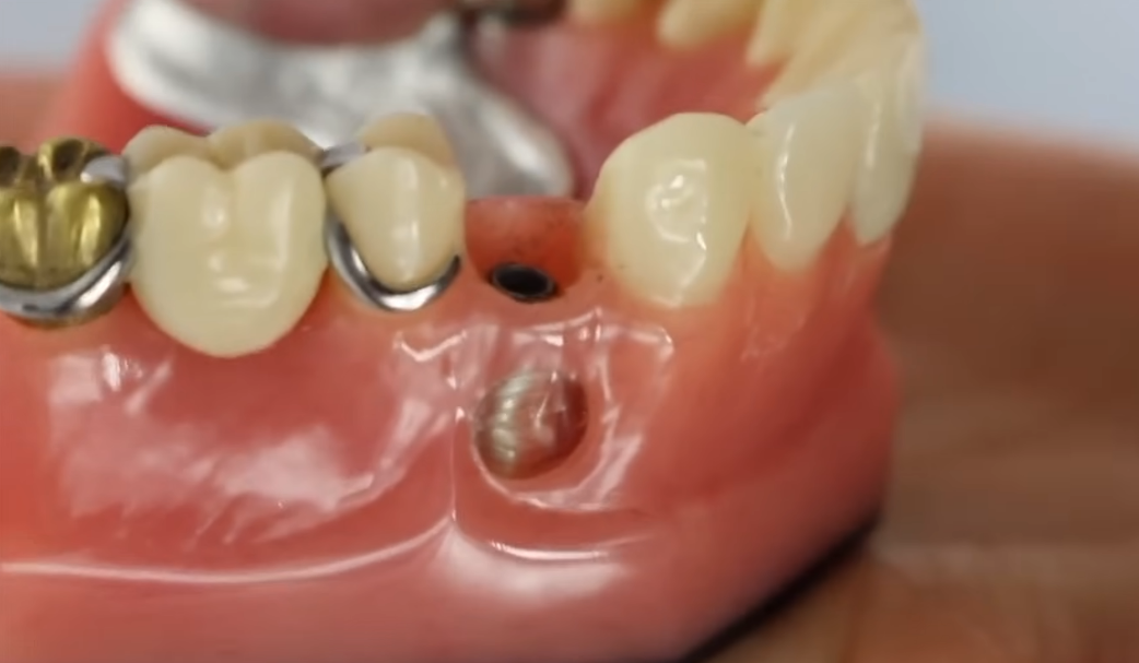 Other Removable Options: Dentures